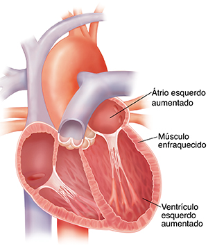 Corte transversal do coração aumentado. As paredes do coração são finas.